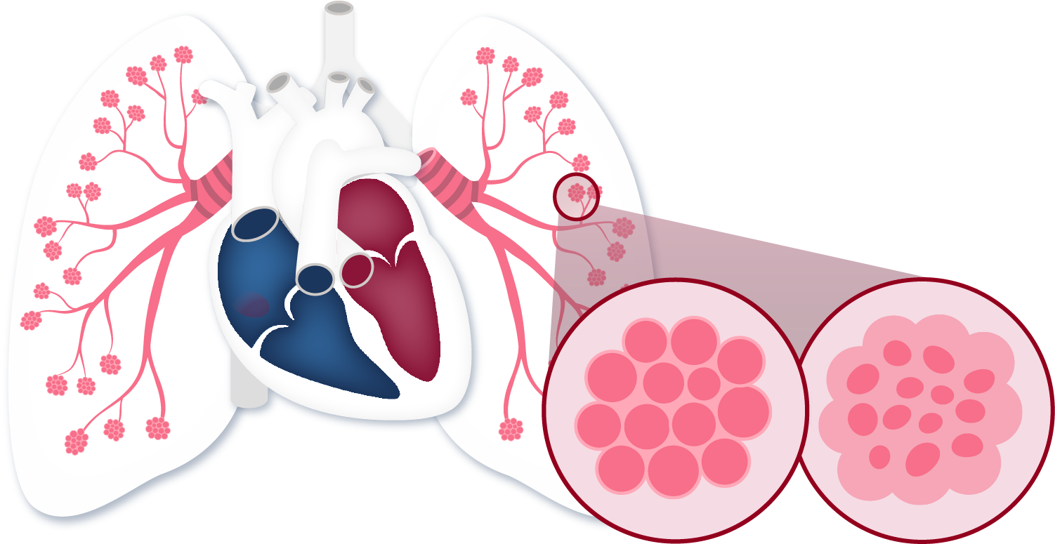 lung showing healthy air sacs versus alveoli damaged by interstitial lung disease