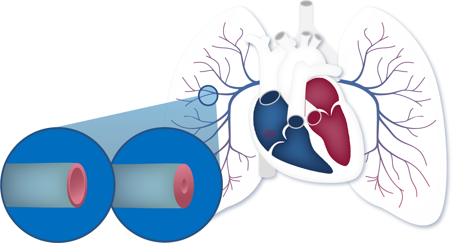 Thickened blood vessels in a lung affected by pulmonary hypertension